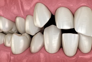 Illustration of crooked, crowded, and overlapping teeth