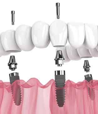 Illustration showing placement of dental implants for All-on-4 treatment