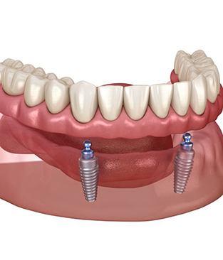 Illustration of removable, ball-retained implant denture